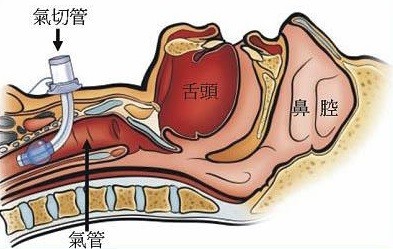 气管切开套管护理要点