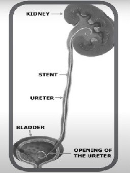 输尿管支架的应用