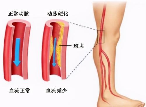 产品推荐：造影导管