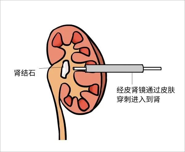 科普 | 经皮肾镜碎石术